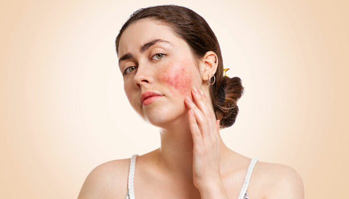 Type of rosacea and how the skin condition can be treated