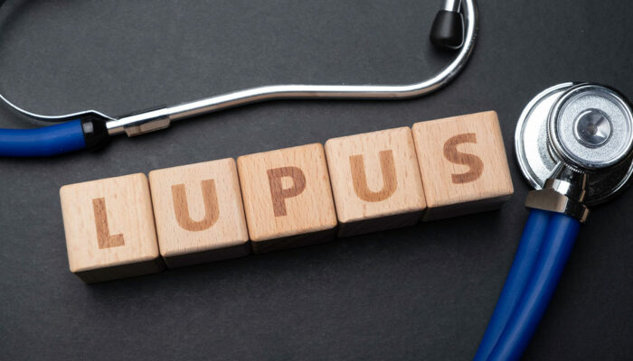 4 things to avoid when dealing with lupus