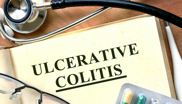 4 signs that indicate ulcerative colitis development