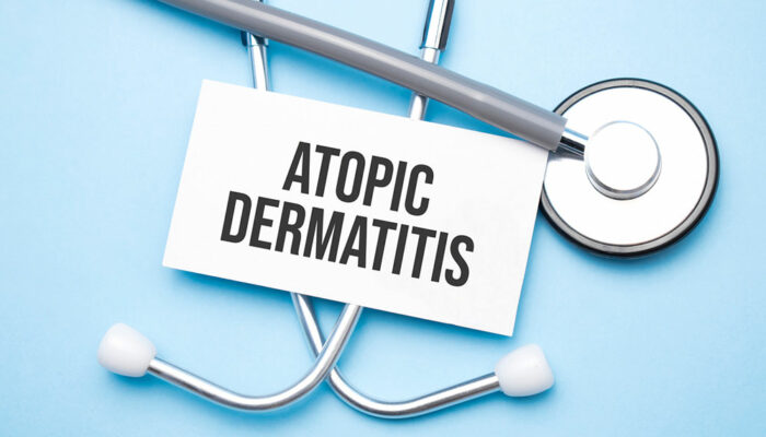 3 strategies for managing atopic dermatitis