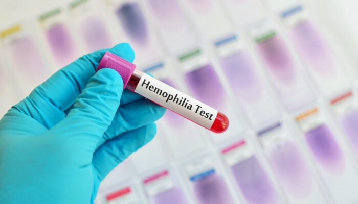 4 best foods for hemophilia