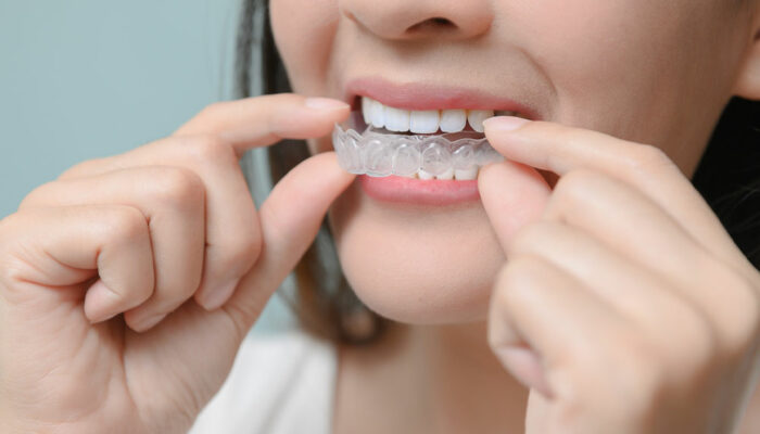 5 benefits of using a dental guard