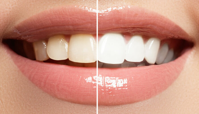 5 reasons at-home teeth whitening isn&#8217;t ideal always