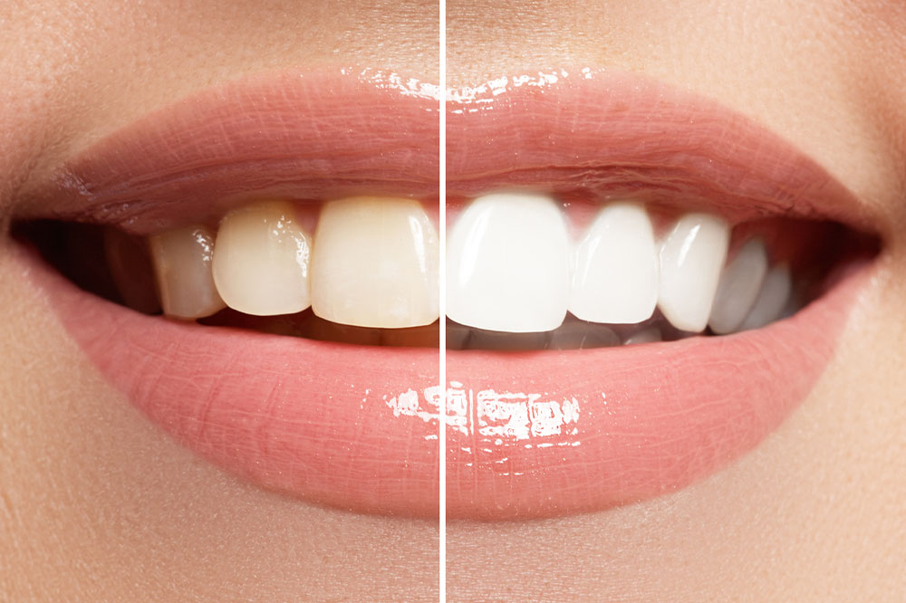 5 tips to achieve a pearly white smile