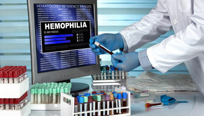 5 ways to live healthy with hemophilia