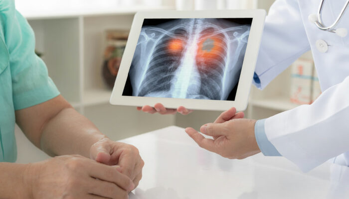 6 signs that indicate a lung disease