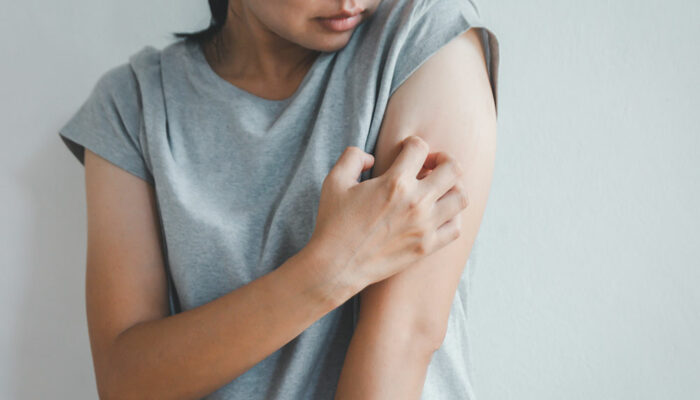 6 useful home remedies to relieve atopic dermatitis