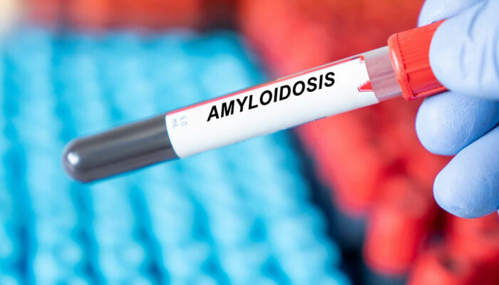 9 early warning signs of amyloidosis to know of