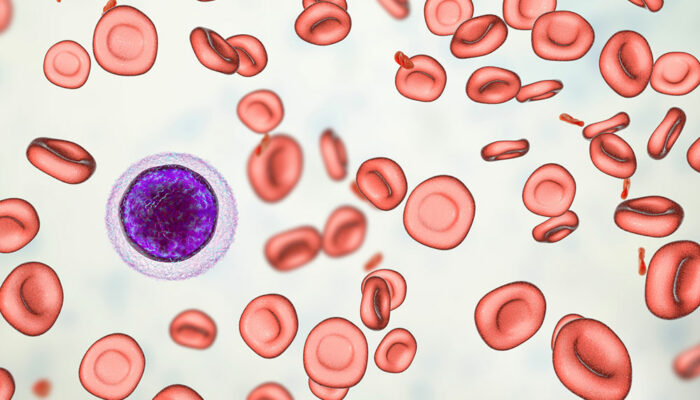 9 signs of anti-neutrophil cytoplasmic antibody vasculitis