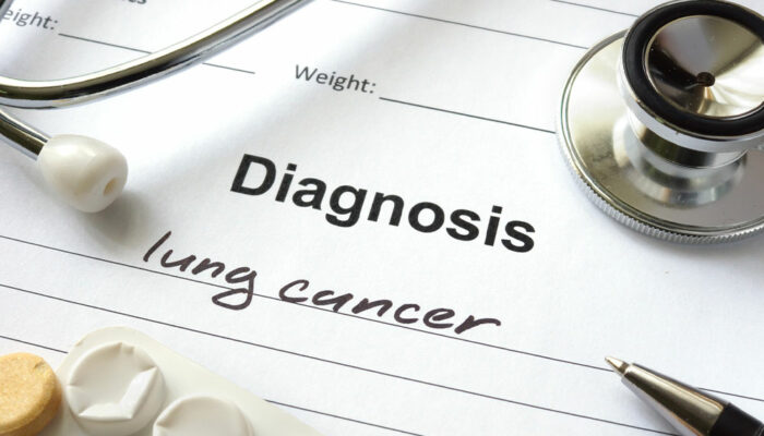 Common signs of lung cancer that should not be ignored