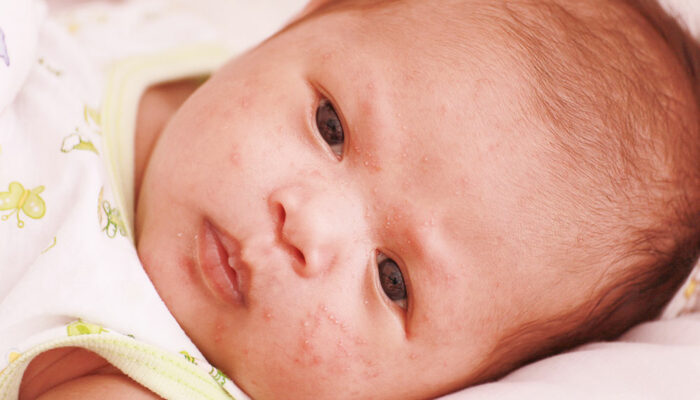 Atopic dermatitis in infants &#8211; Signs and management tips