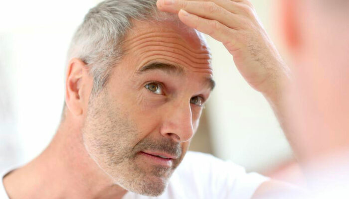 Essential Vitamins for Preventing Hair Loss