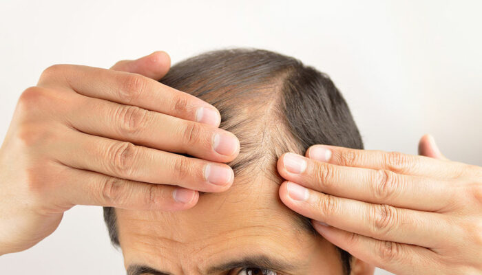 Ways to manage hair loss