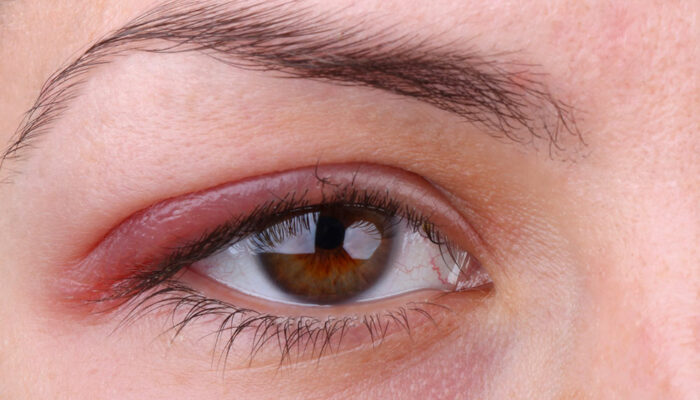 Top 3 conditions that affect eye health