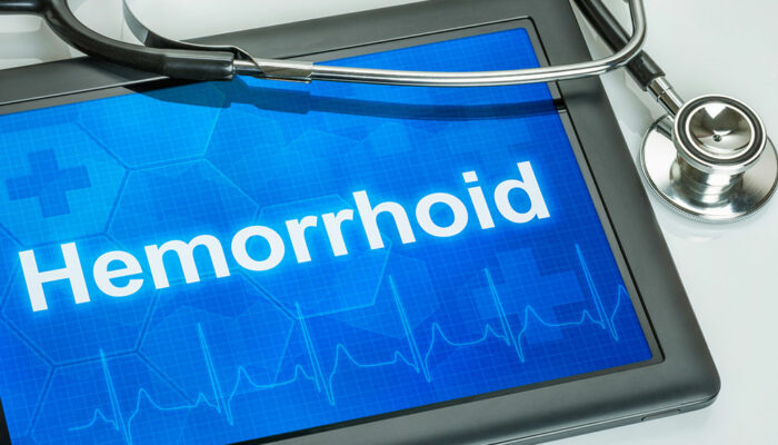 Best ways to manage hemorrhoids